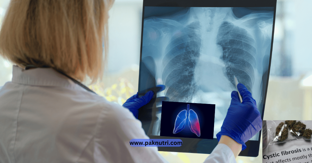 Cystic Fibrosis Diet and Nutrition